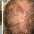 How long does it take for vitamins to work for hair loss?